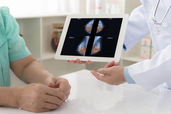 Breast cancer dcis treatment study