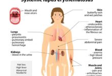 How lupus affects weight autoimmune diseases