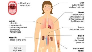 How lupus affects weight autoimmune diseases