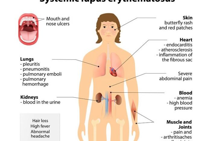 How lupus affects weight autoimmune diseases