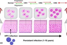 What does hpv diagnosis mean sti