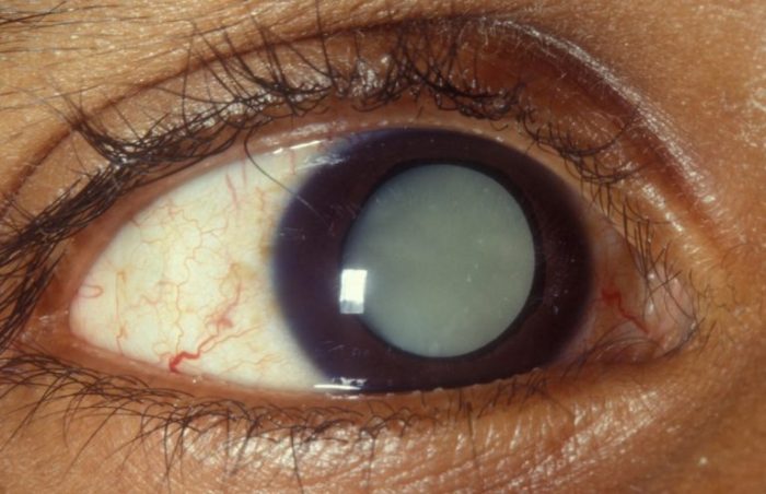 Cataract surgery what to expect